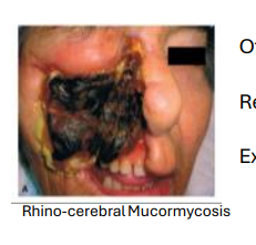 <ul><li><p>Often has life-changing impact</p></li><li><p>Systemic mucormycosis has a<strong> mortality rate of ~90%</strong></p></li><li><p>Requires surgical <strong>intervention/reconstruction</strong></p></li><li><p>Extensive antifungal therapy</p></li></ul><p></p>