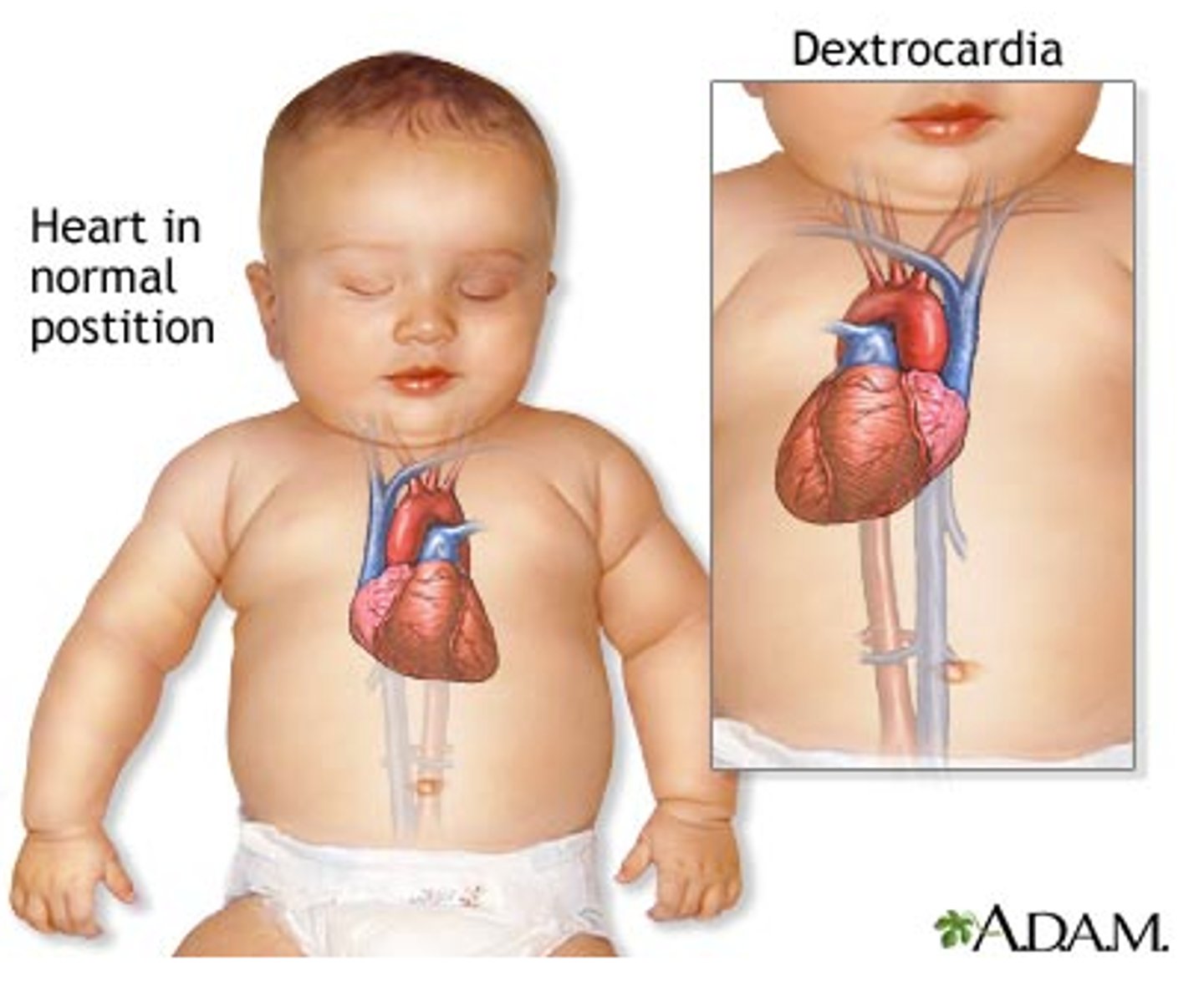 <p>When heart is on opposite side of the body</p>