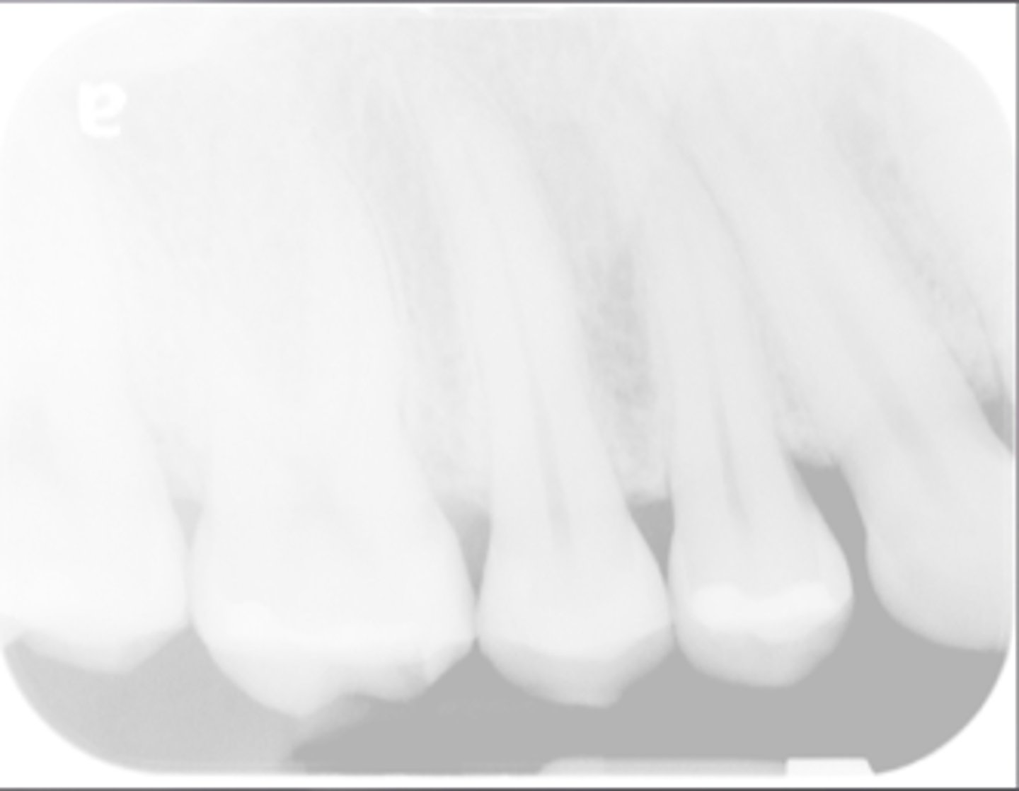 <p>-Low density (faint) image</p><p>-Too low kvp or mA</p><p>Incorrect Processing Factors</p><p>-Underdeveloped during processing</p><p>-Developer temperature too cold</p><p>-Developer concentration diluted</p><p>-Contaminated or old developer solution</p>