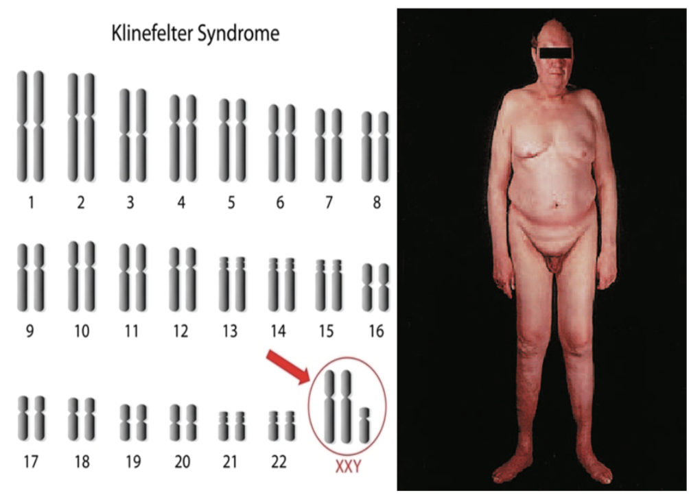 <p>Klinefelter (XXY)</p>
