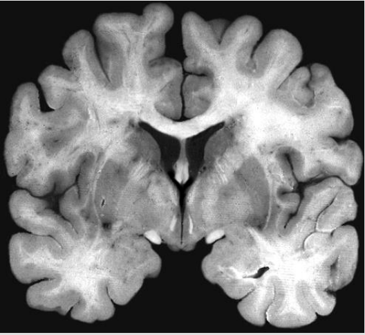 <p>Separates the brain from front to back (Butterfly)</p>