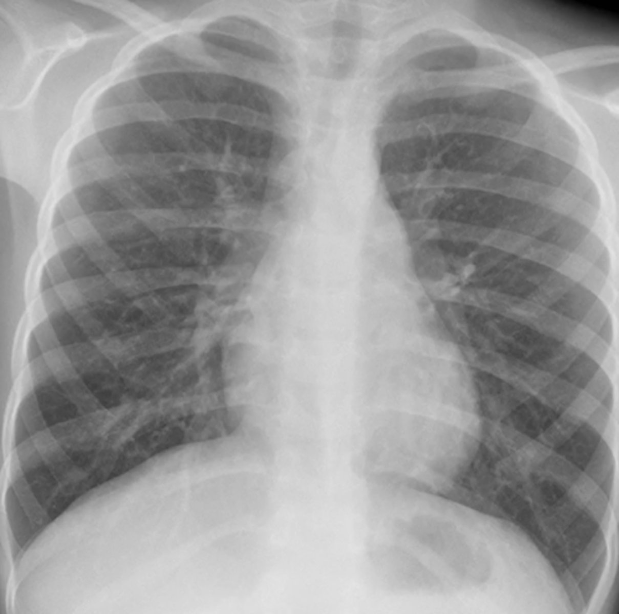 <p>(evaluating AP CXR) airway eval</p>