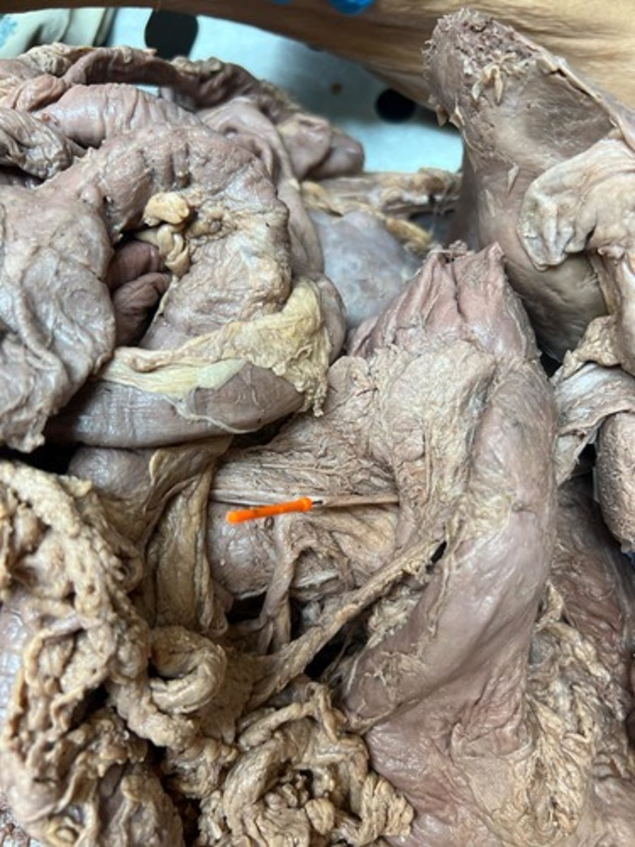 <p>superior mesenteric vain</p>