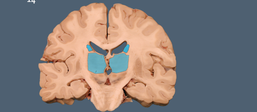 <p>the caudate and the thalamus are sisters. how to tell them apart.&nbsp;</p>