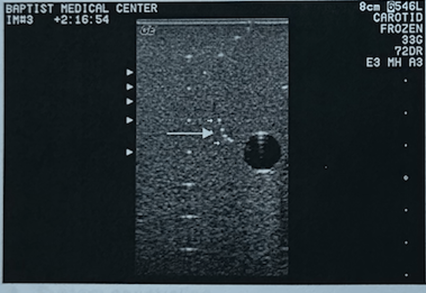<p>The rods depicted by the arrows in this phantom are used to determine what feature of the machine?</p><p>A. Contrast resolution</p><p>B. Penetration</p><p>C. Lateral resolution</p><p>D. Measurement accuracy</p><p>E. Axial resolution</p>