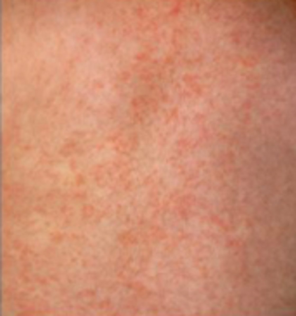 <p>Exanthems:</p><p>Subjective:</p><p>- 3-5 days of fever and irritability</p><p>- Rash following fever</p><p>Most children are otherwise well-appearing, active, and alert. </p>