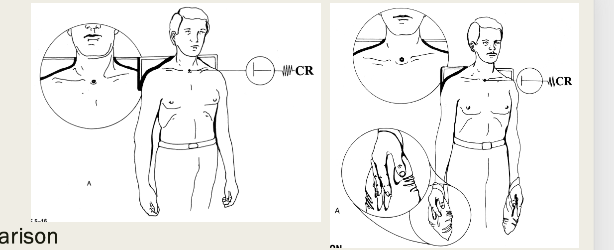 <p>AP with/without weights (AC joints)&nbsp;</p><ul><li><p>AP shoulder  position&nbsp;</p></li><li><p>minimum 10lb weights&nbsp;</p></li><li><p>72in SID&nbsp;</p></li><li><p>include both shoulders</p></li><li><p>CR 1in above jugular notch</p></li></ul><p></p>