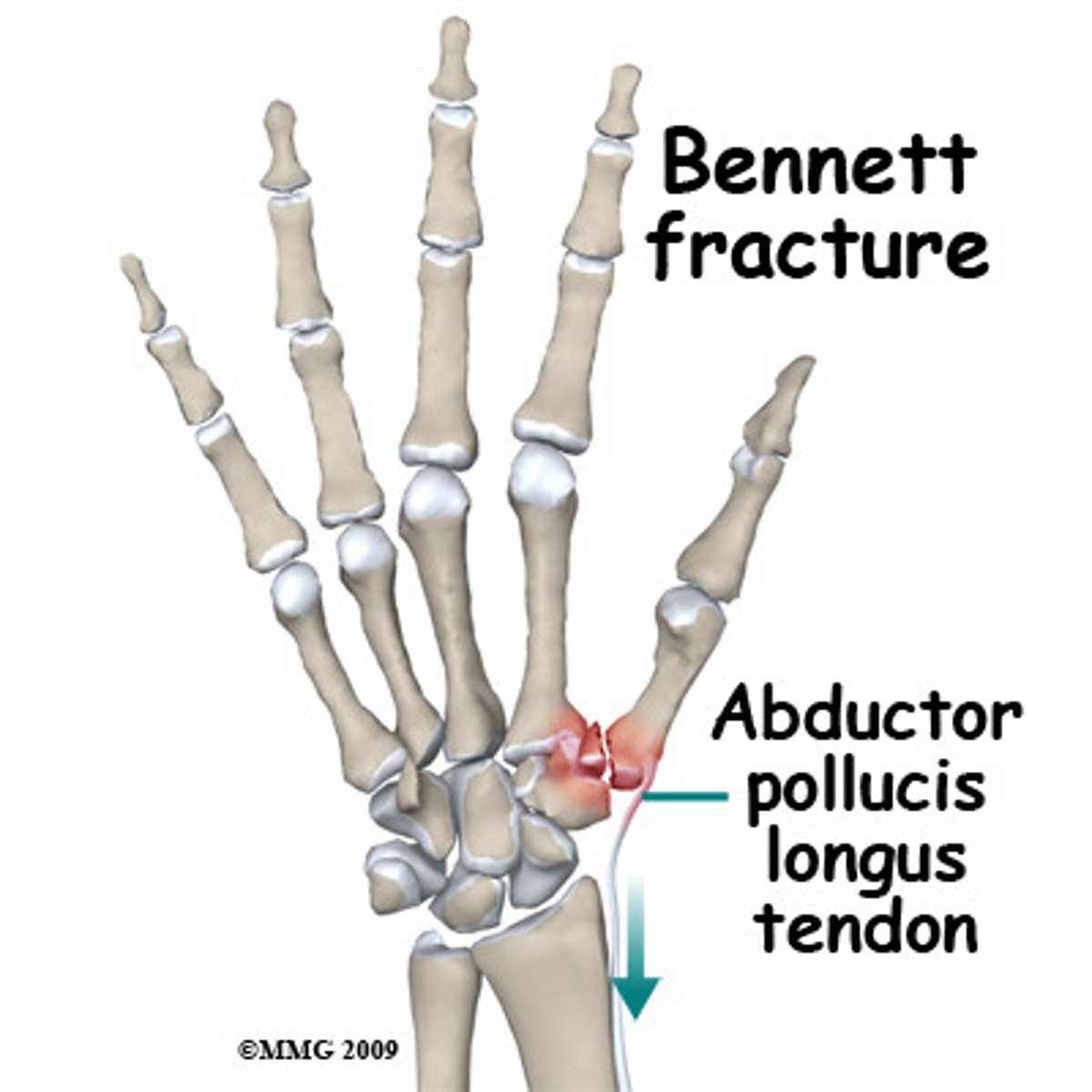 <p>bennett's fracture → causes swelling and pain at the thumb base (CMC)</p>