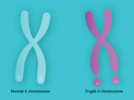 <p>Fragile X syndrome is a genetic disorder caused by an expansion of the CGG repeat in the FMR1 gene on the X chromosome. This results in reduced or absent production of the FMR1 protein, leading to a range of cognitive and behavioral problems. It is an X-linked dominant disorder, affecting males more severely than females because female shave another X and, therefore FMRI1 gene.</p>