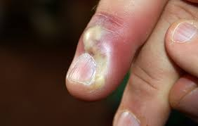 <p>PP: inflammation of the nail fold</p><p>E: bx<br>secondary candida colonization</p><p>CM: erythema<br>swelling<br>throbbing pain<br>pustular drainage</p><p>TX: topical+systemic abx</p>