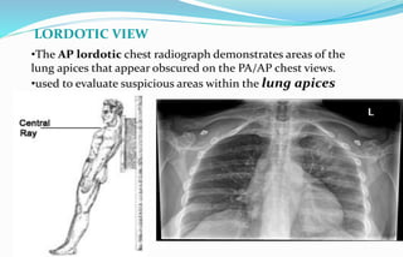 <p>Lordotic view </p>