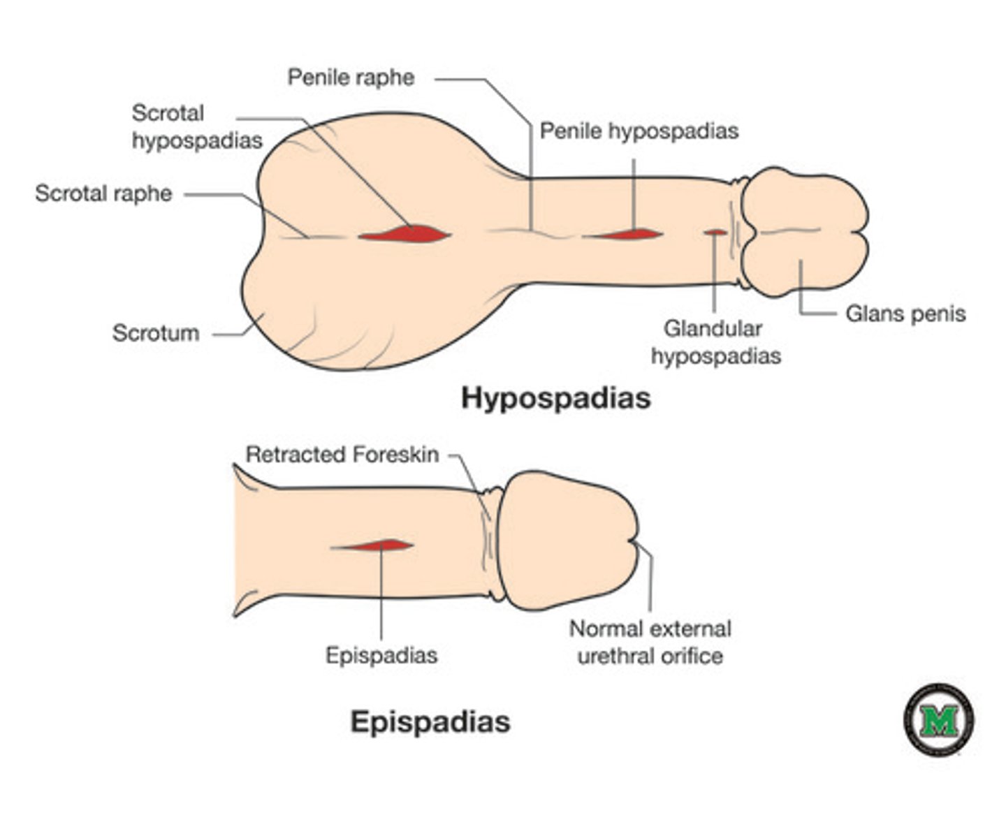 <p>congenital defect in which the urinary meatus is located on the underside of the penis; a similar defect can occur in the female</p>