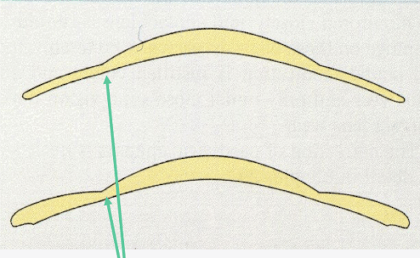 <p>edge thickness > junctional thickness</p><p>image - bottom lens</p>