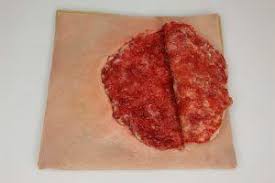 flap of flesh created from a cut

