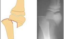 <p>What type of fracture is this?</p>