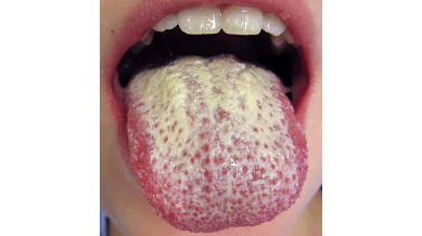 <p>What causes oral thrush</p>