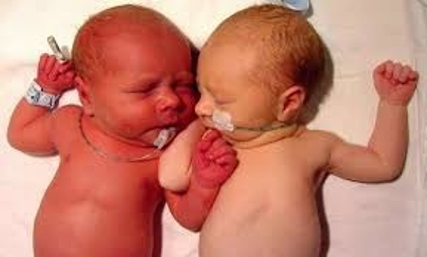 <p>may indicate neonatal polycythemia</p>