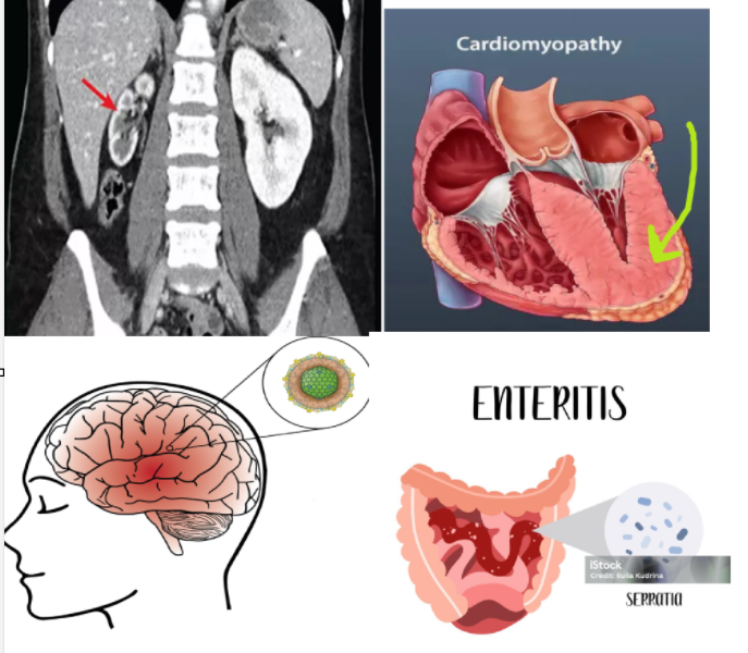 <ol><li><p>renal atrophy</p></li><li><p>cardiomyopathy</p></li><li><p>encephalitis</p></li><li><p>enteritis</p></li><li><p>psychosocial effects</p></li></ol><p></p>