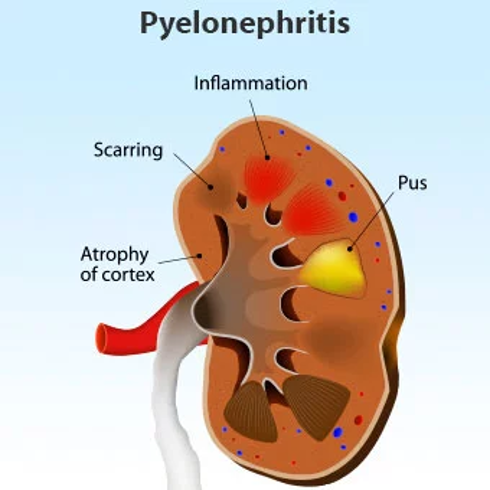 <p><span>Pyelonephritis – Clinical Manifestations</span></p>