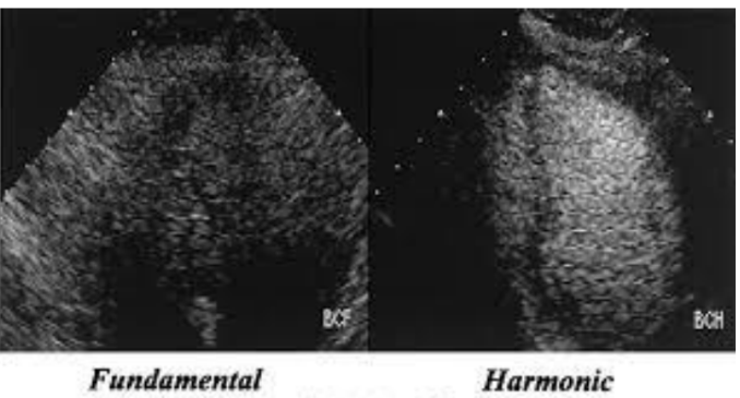 <p>(1) gas-contained microbubbles are good contrast agents as gas is 100,000x less dense than blood</p><p>(2) blood, tissues, and gas have a huge impedance mismatch, causing increased brightness to the area of interest</p><p>(3) bubbles distort and create harmonic energy</p><p>(4) agitated saline microbubbles enhance blood echoes by introducing multiple liquid-gas interfaces</p><p>(5) microbubbles are dissolved rapidly in blood and lose echogenicity</p><p>(6) brands: optison, levovist, definity</p>