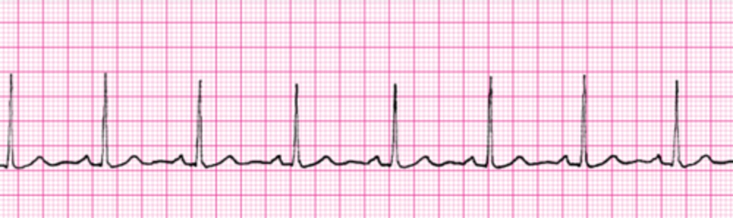 <p>Ventricular rate: 60-100</p>
