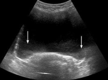 <ul><li><p><span style="background-color: transparent;">AKA Partial Volume Filling</span></p></li><li><p><span style="background-color: transparent;">Beam is too thick in the elevation plane</span></p></li><li><p><span style="background-color: transparent;">Gives the appearance of debris in an echo-free structure</span></p></li></ul><p></p>