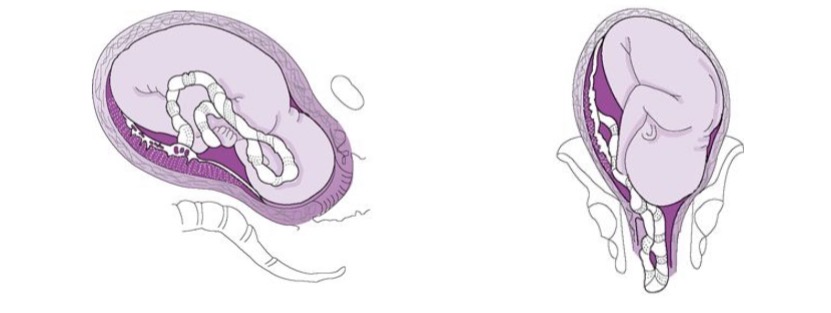 <p>Occult: alongside presenting part</p><p>Overt: over/past the head</p>