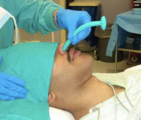 <p>nasotracheal tube</p>