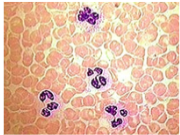 <p><span style="background-color: transparent; font-family: "Times New Roman", serif;">*Idiopathic disorder characterized by <strong>increased mass of rbcs </strong></span></p><p><span style="background-color: transparent; font-family: "Times New Roman", serif;"><strong>and abnormal proliferation of marrow stem cells</strong> </span></p><p><span style="background-color: transparent; font-family: "Times New Roman", serif;">*Myeloproliferative Disease</span></p><p><span style="background-color: transparent; font-family: "Times New Roman", serif;">*Increase in wbcs and platelets</span></p><p><span style="background-color: transparent; font-family: "Times New Roman", serif;">*Cells function normally, just in excess (very crowded smear)</span></p><p><span style="background-color: transparent; font-family: "Times New Roman", serif;">→ % of rbcs in blood may be so high </span></p><p><span style="background-color: transparent; font-family: "Times New Roman", serif;">→ <strong>blood ceases to flow in some smaller vessels and capillaries</strong></span></p>