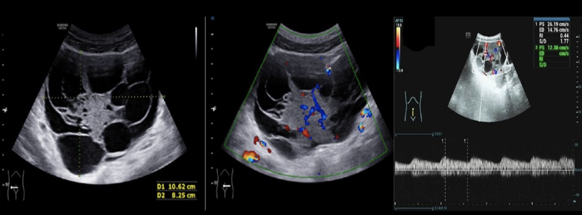 <p>which ovarian tumor causes serum levels of AFP to rise</p><p>a) mucinous cystadenocarcinoma</p><p>b) yolk sac tumor</p><p>c) dysgerminoma</p><p>d) krukenberg tumor </p>