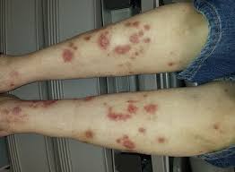 <p><span>This is a vague term meaning "the thing that is wrong with the patient." A lesion may be a TUMOR or an area of INFLAMMATION.</span></p>
