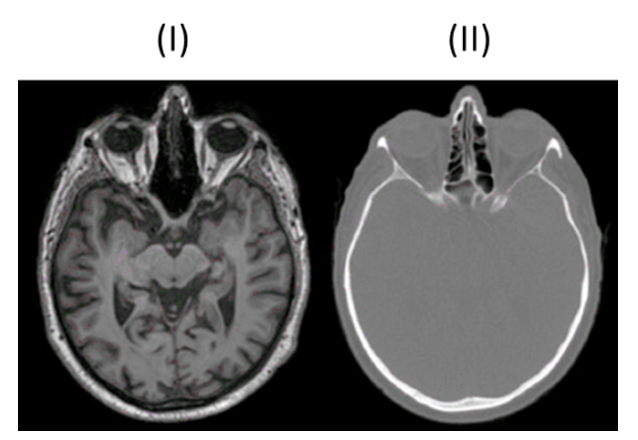 <p>Erzeugung Graustufenbildern basierend auf Anregung der Wasserstoffprotonen im Gewebe</p><p>T1-Wichtung: Hervorhebung fetthaltiger Strukturen → Knochen schwarz, Fettgewebe weiß </p><p>T2-Wichtung: Hervorhebung wasserhaltiger Strukturen → Liquor weiß, weiße Substanz dunkelgrau</p><p></p>