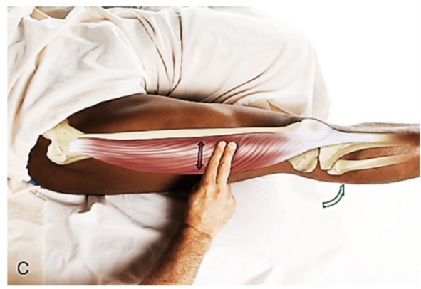 <p>vastus lateralis</p>