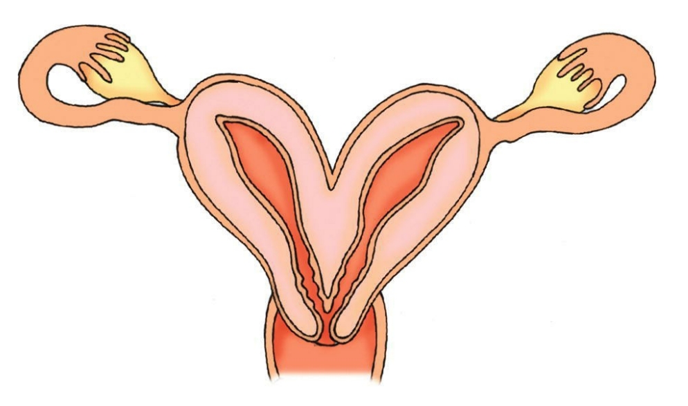 <p>At a preconception visit, a 24-year-old client is found to have malformation of the uterus. The nurse uses the figure below to explain which type of uterine malformation?</p><p>□ 1. septate uterus</p><p>□ 2. bicornuate uterus</p><p>□ 3. double uterus</p><p>□ 4. uterus didelphys</p>