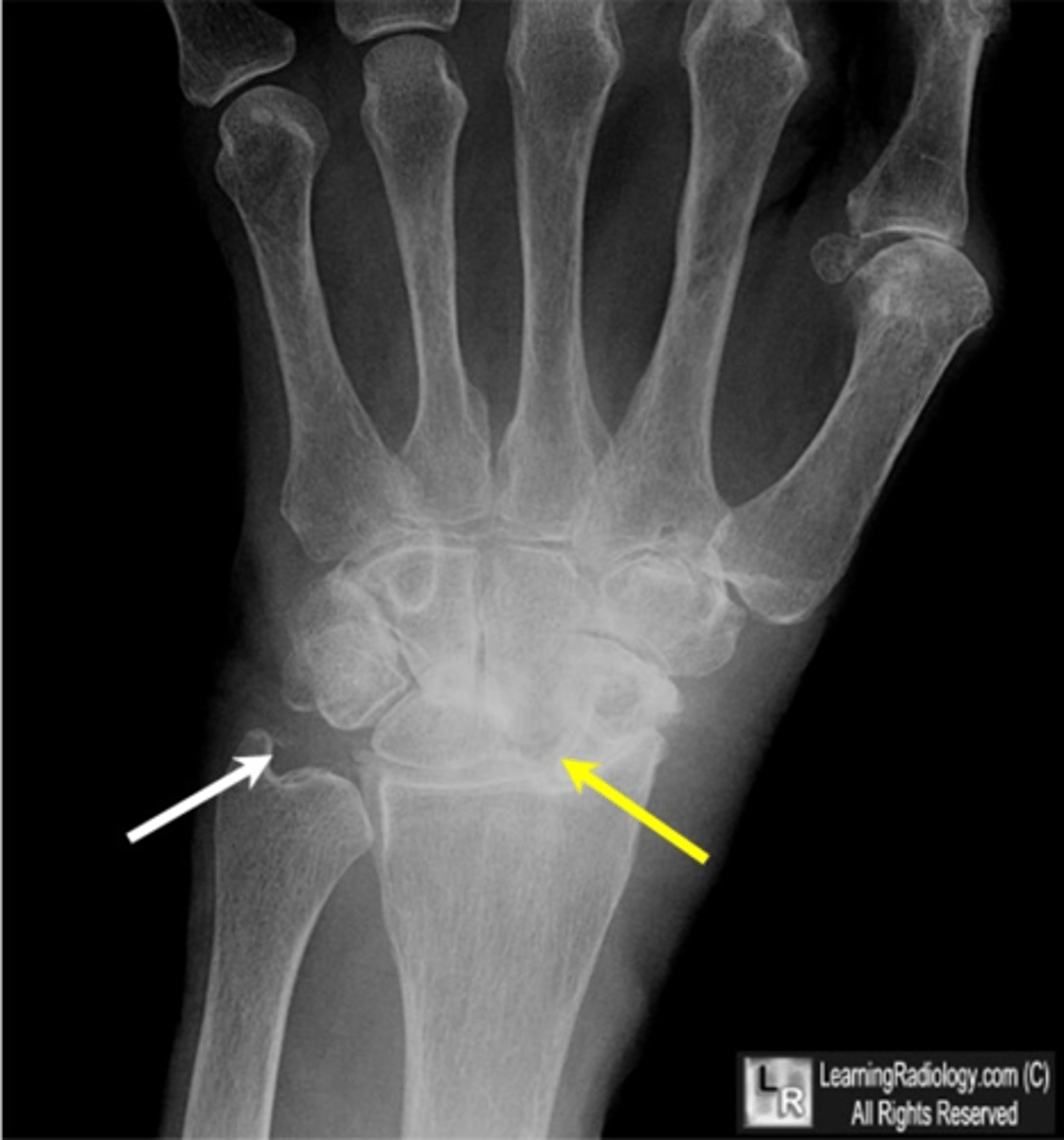 <p>State the radiographic findings of calcium pyrophosphate dihydrate crystal deposition disease (CCPD)</p>