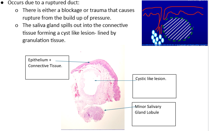 <p>Who→ younger age groups</p><p>Where → lower lip</p><p>Due to ruptured duct:</p><p>Blockage or trauma → rupture from build up of pressure → gland spills out into connective tissue forming cyst like lesion - lined by granulation tissue</p>