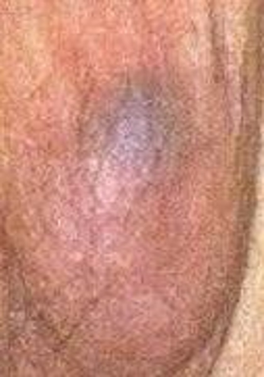 <p>Acute scrotal pain, swelling, edema, erythema, absent cremaster reflex, "blue-dot" sign</p>
