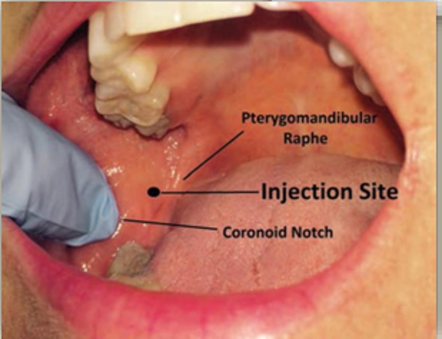 <p>3 quarters of the way between the coronoid notch and the pterygomandibular fold, and you're going to be coming across from the opposite premolar</p>