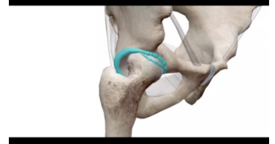 <p>Labral Tear</p>