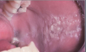 <p>biting trauma on buccal mucosa </p>