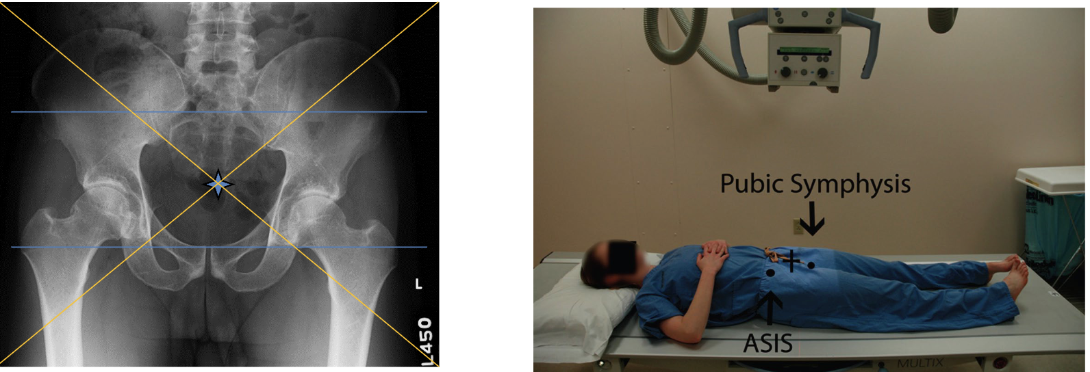 <p>Broad FS, 100cm</p><p>78kVp, 25mAs</p><p>Straight tube</p><p>CR: midline 5cm superior to level of greater trochanter</p>
