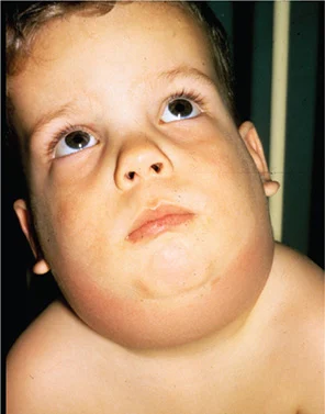 <p>Mumps</p>
