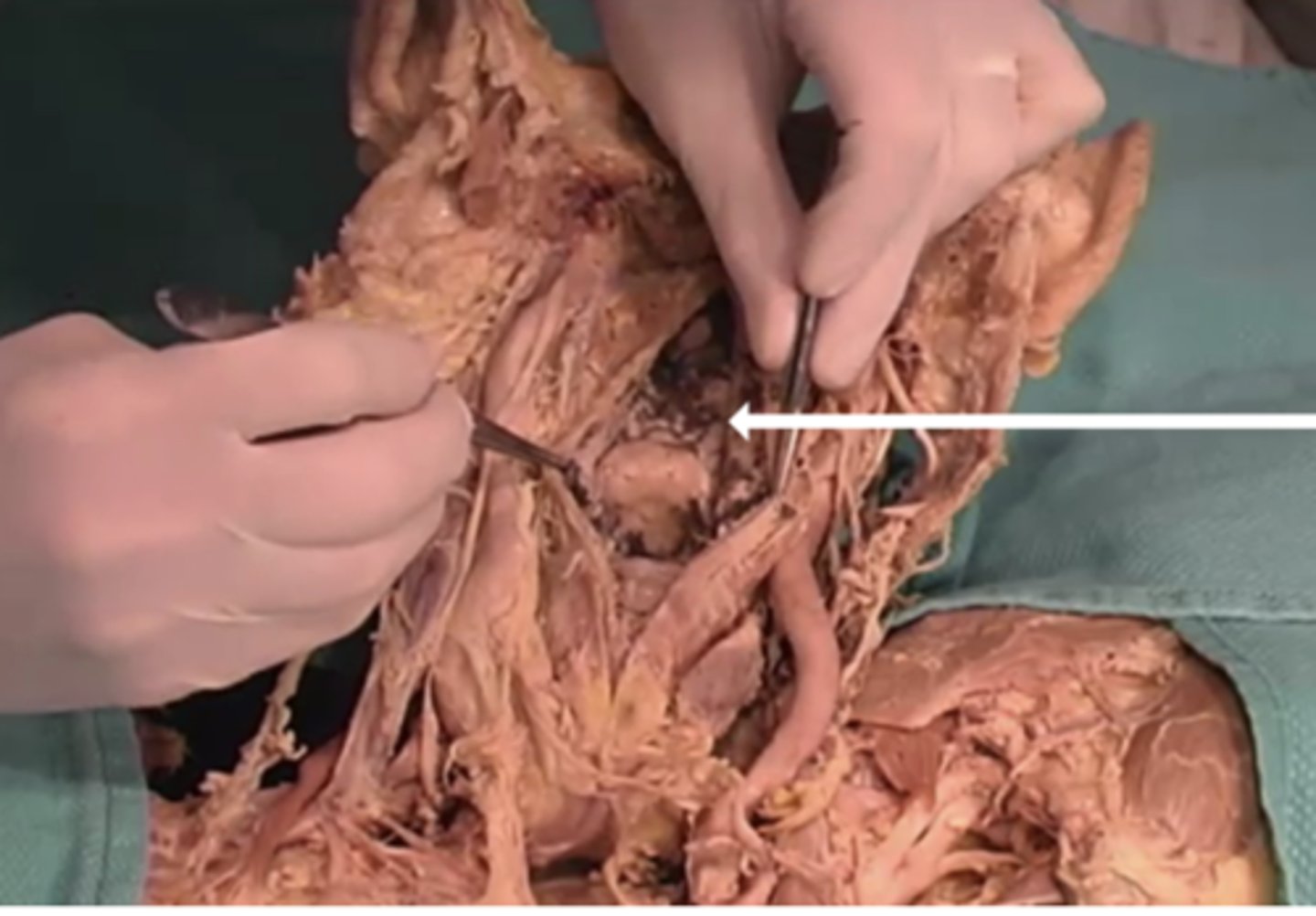 <p>-throid</p><p>-pharynx</p><p>-brain stem</p><p>-larynx</p>