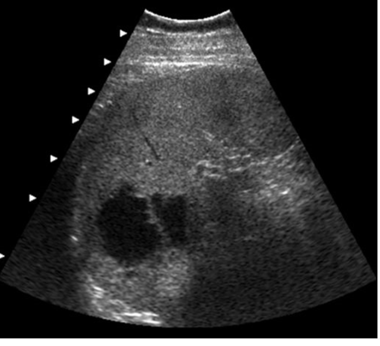 <p>This patient was regerred for an abdominal ultrasound because of epigastric pain and tenderness. This image was obtained from the left upper quadrant. Which of the following describes the ultrasound findings?</p><p>a. pleural effusion</p><p>b. splenomegaly</p><p>c. ascites</p><p>d. splenic metastases</p><p>e. splenic cysts</p>