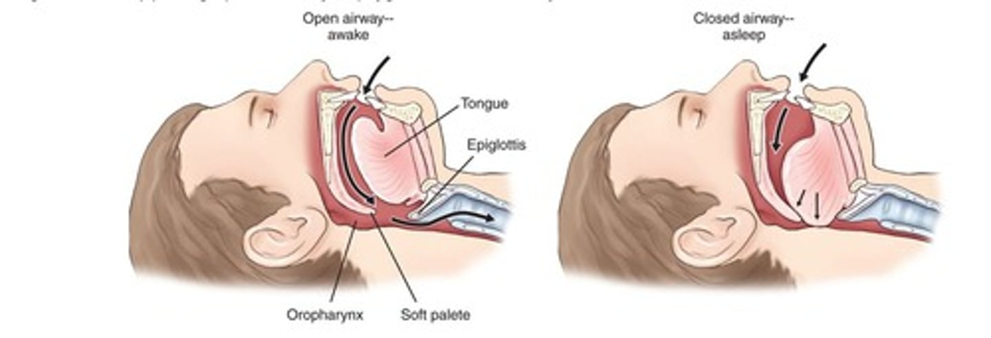 <p>repetitive pharyngeal collapse during sleep, which leads to transient periods of apnea (absence of breathing); can produce daytime drowsiness and elevated blood pressure</p>