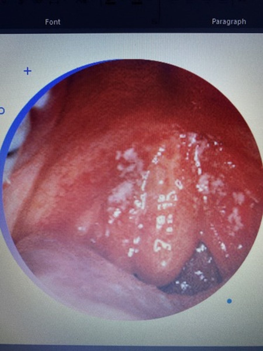 <p>Candidiasis</p>