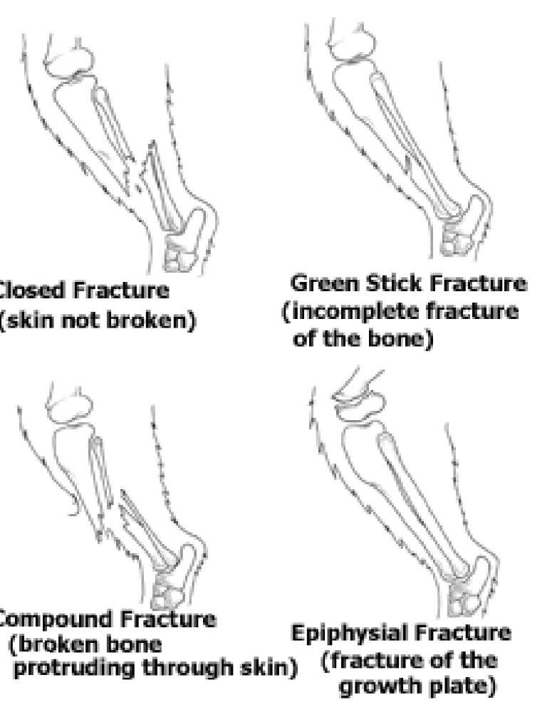 <ul><li><p><strong>Closed </strong></p></li><li><p><strong>open </strong></p></li><li><p><strong>By location: </strong></p><ul><li><p>humerus</p></li><li><p>radius</p></li><li><p>femur </p></li><li><p>tibia</p></li></ul></li></ul><p>can be on proximal epiphysis, diaphysis and distal epiphysis. </p>