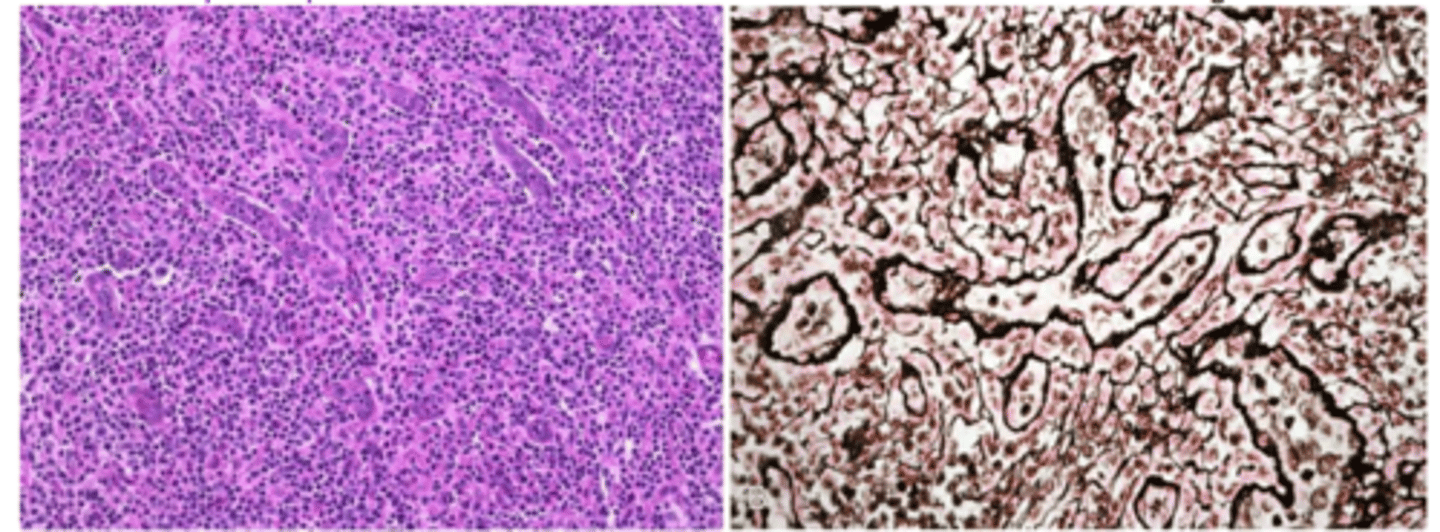 <p>-medium sized neoplastic T cells with moderate and abundant pale cytoplasm</p><p>-pronounced proliferatioin of arborizing high endothelial venules</p>