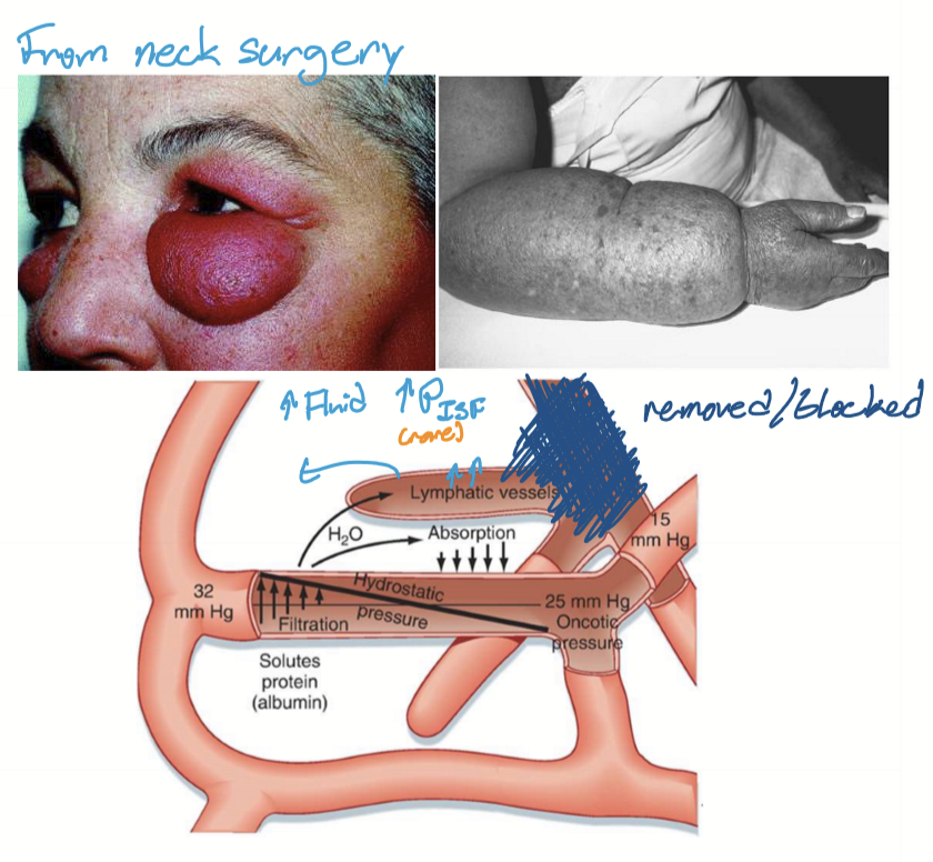 <p>Edema caused by occlusion or removal of lymph nodes. </p>
