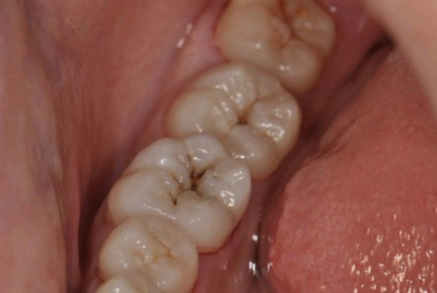 <p>How would you define the structural damage to this tooth?</p>